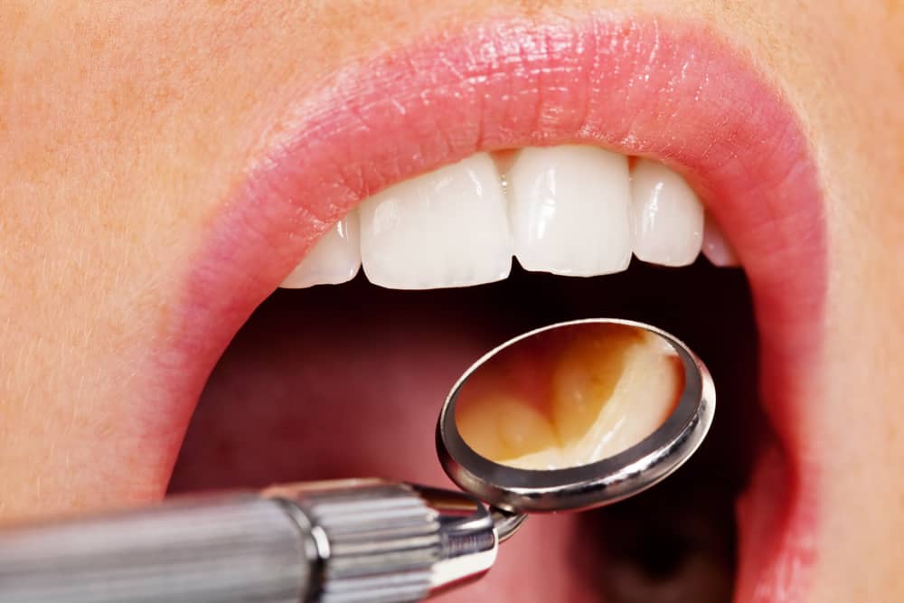 Dental mirror in mouth
